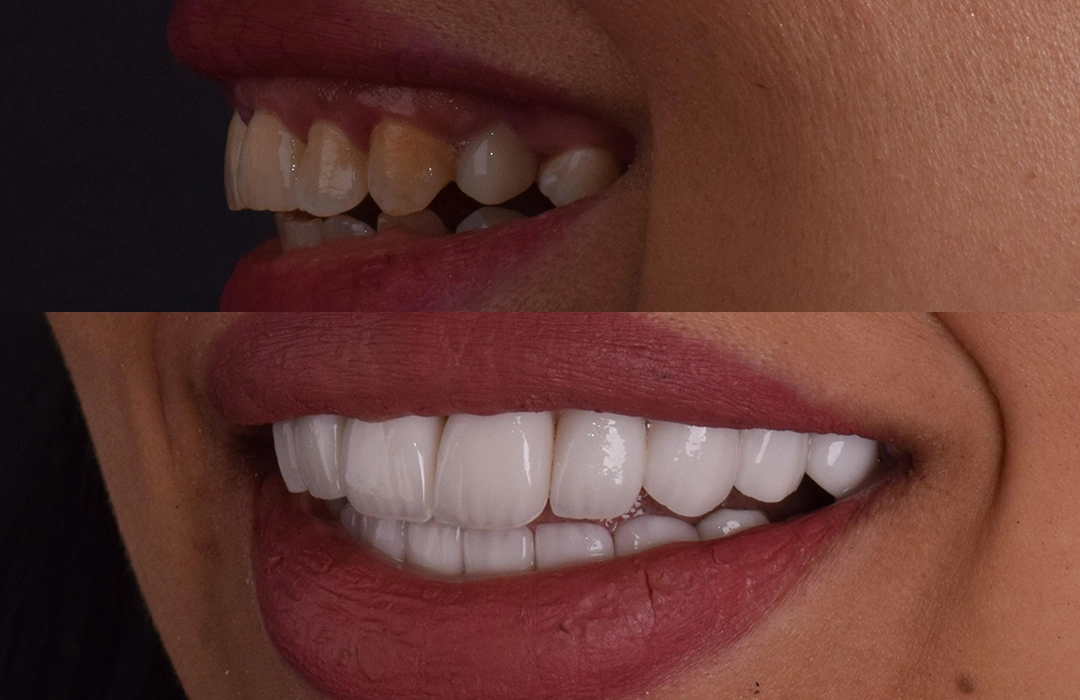 All-on-4 Dental Implants Egypt - Cost, Process & Results in Cairo (2026)