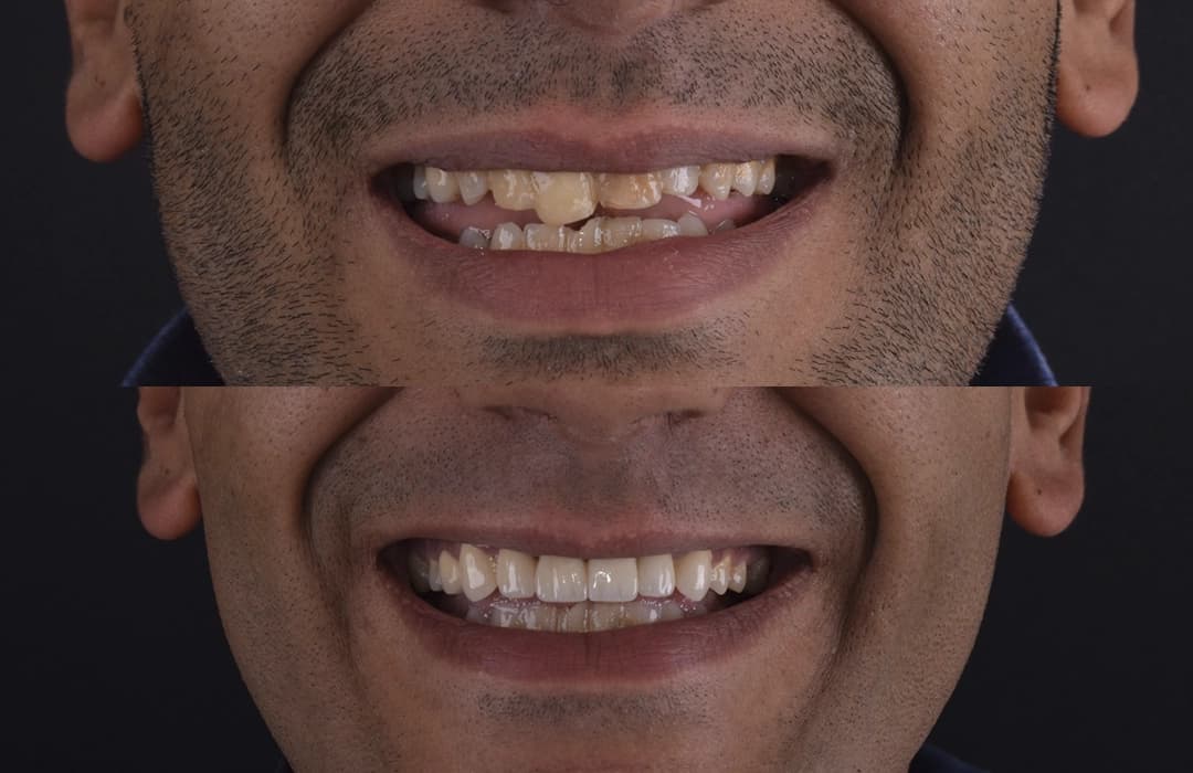 Root Canal Treatment Egypt: Cost & Results Cairo (2026)
