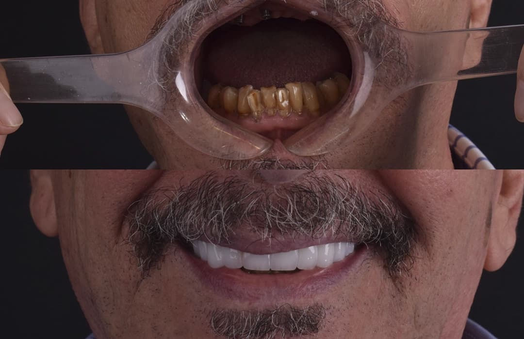 Premium Dental Crowns at Helio Dental Clinics Cairo Egypt