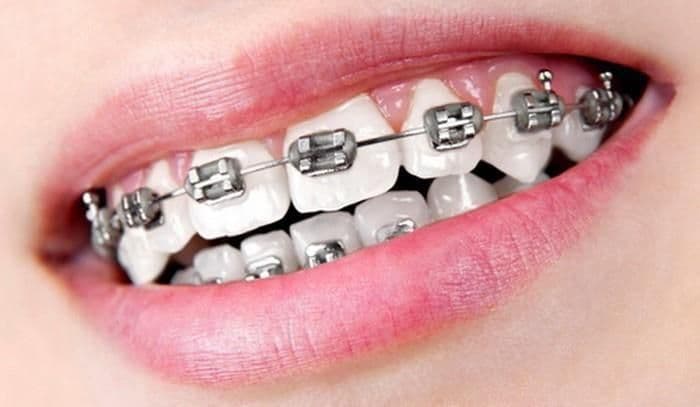 Traditional metal braces