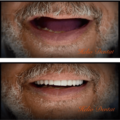 Best Dentist Cairo Before After Results - International Patient Transformation