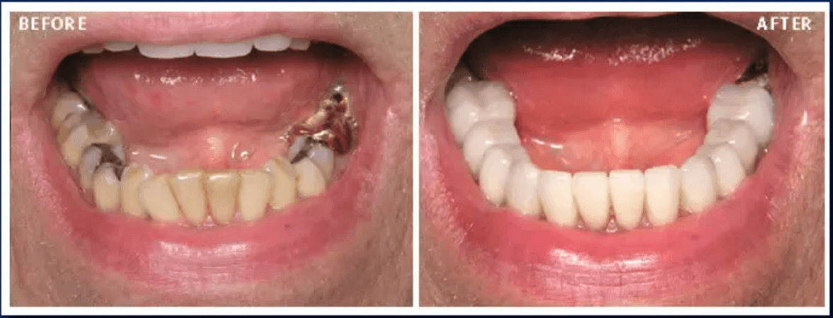 Fix Crooked Teeth Without Braces Before After Results Egypt