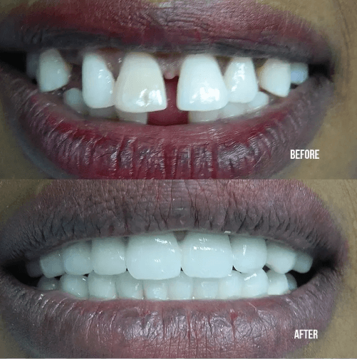 Dental Tourism Egypt Before After - Smile Transformation Results