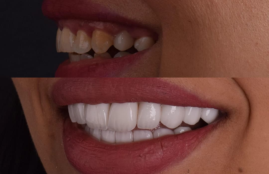 All-on-4 Dental Implants in Egypt: Costs, Process & Why Patients Travel to Cairo (2026)