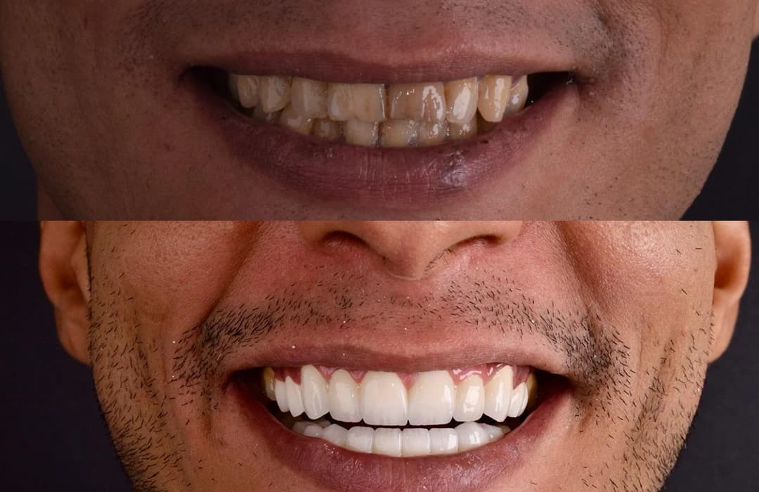 Professional Teeth Whitening Results at Helio Dental Clinics Cairo Egypt