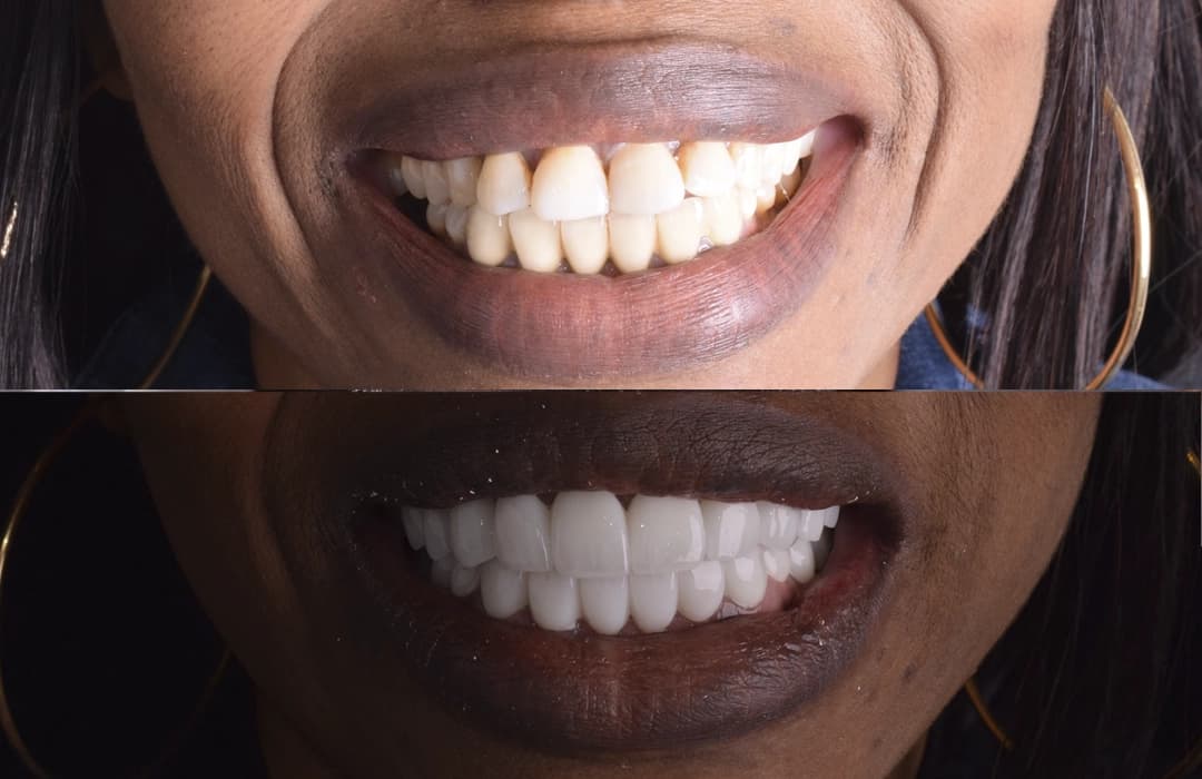 Before and after porcelain veneers at Helio Dental Cairo - UK patient smile makeover
